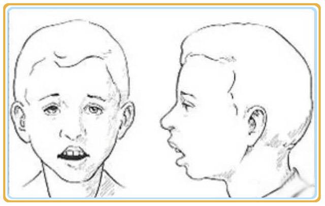 长期张嘴呼吸面容图片(张口呼吸后变丑的图片)