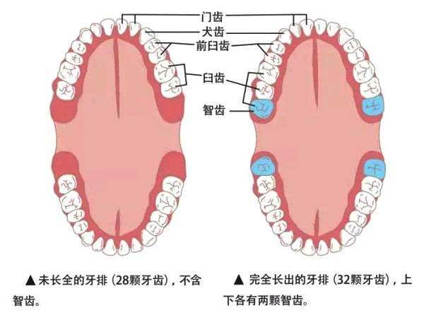 智齿没拔干净会导致什么后果(智齿不拔有什么危害)